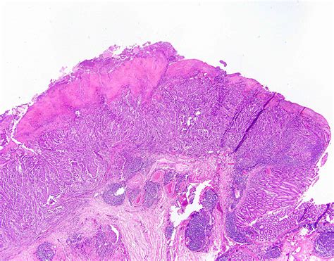 melanoma colon pathology outlines